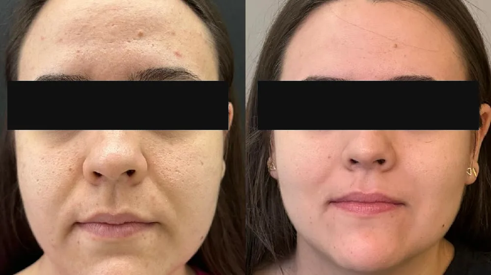 Antes e depois de paciente com acne no rosto, com os olhos cobertos por tarja