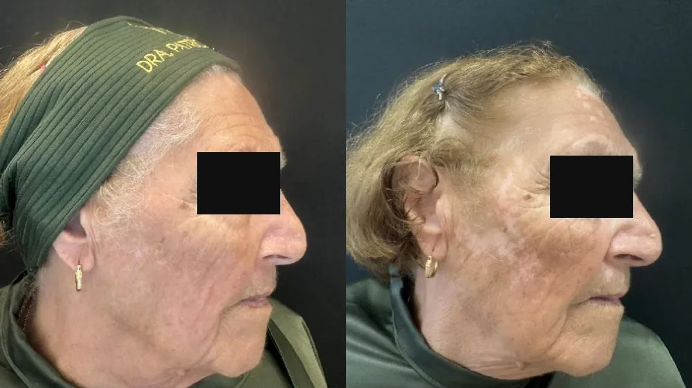 Antes e depois de paciente com sinais de envelhecimento da pele, de perfil, com os olhos cobertos por tarja