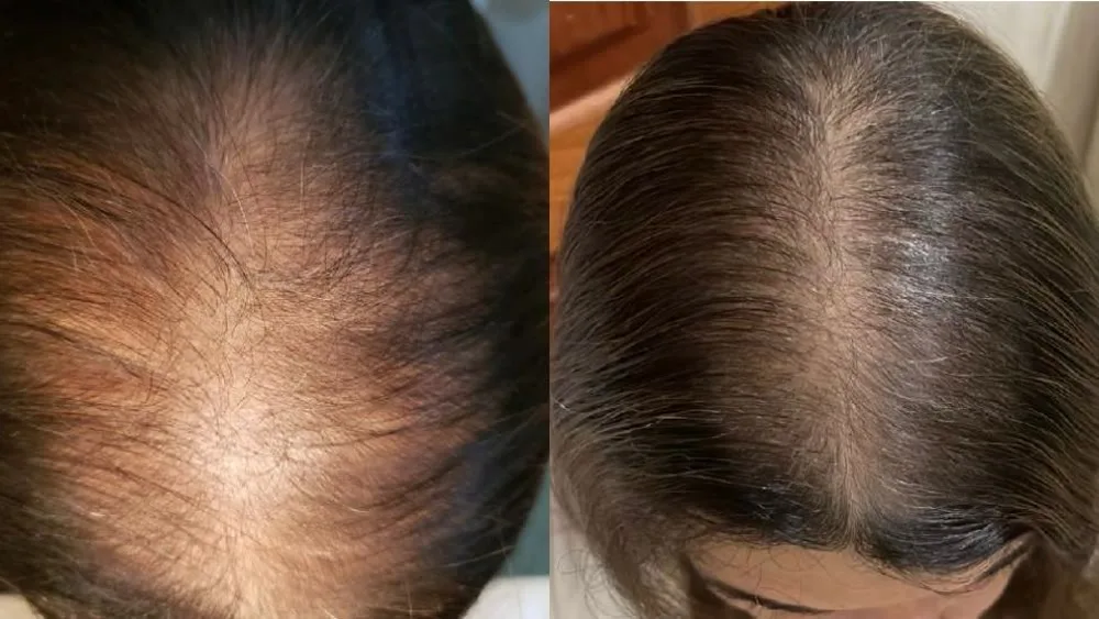 Antes e depois do couro cabeludo de paciente com queda de cabelo, visto de cima