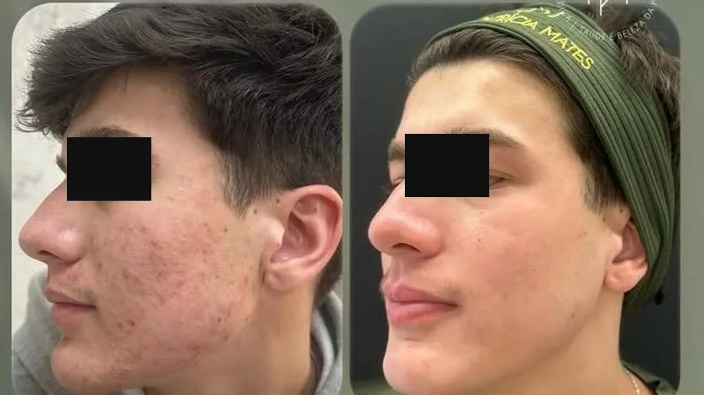 Antes e depois de paciente com acne na face, de perfil, com os olhos cobertos por tarja